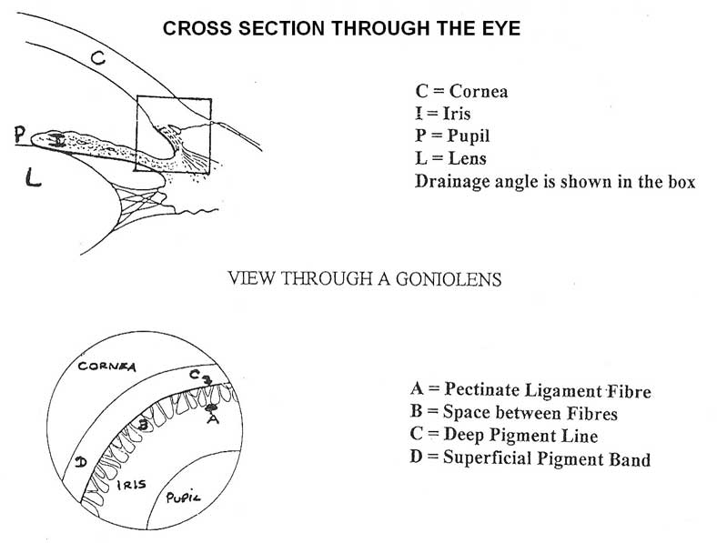 glaucoma_diagram